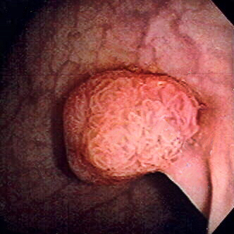 A polyp in the colon