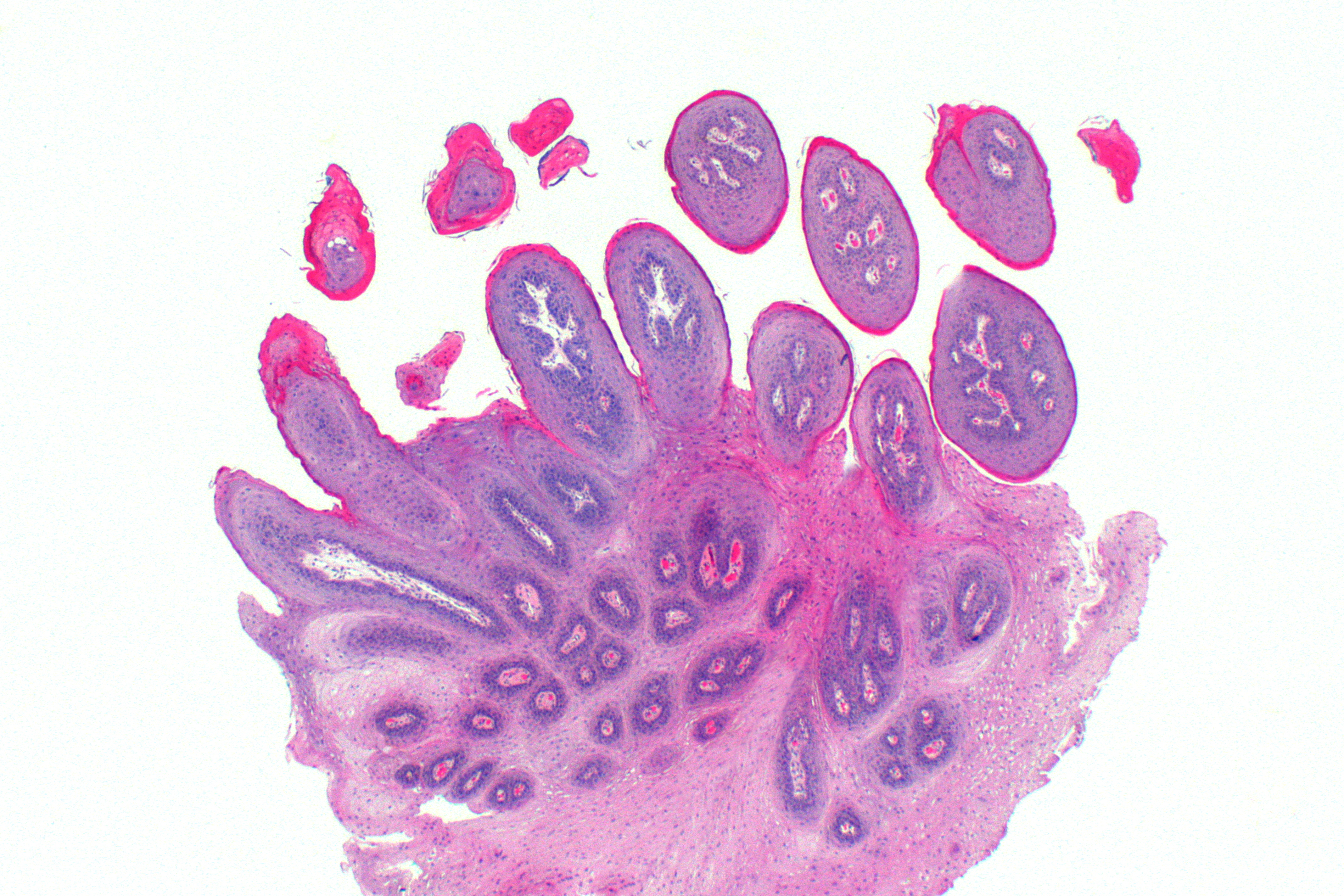 Squamous cell papilloma under microscope