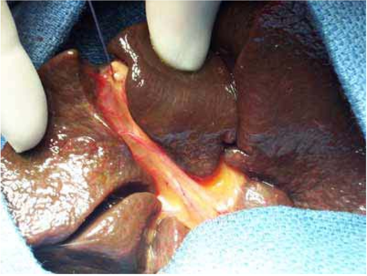 Diagram showing biliary atresia