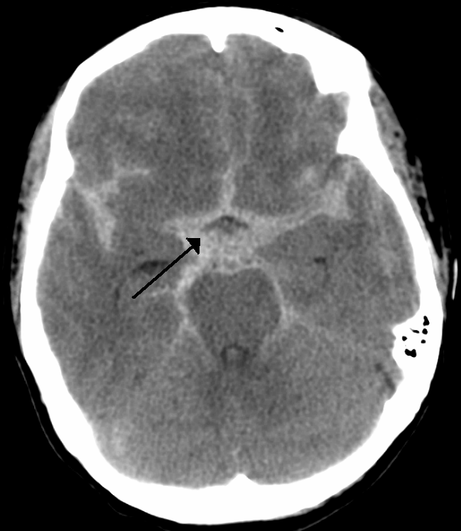 CT scan showing subarachnoid hemorrhage