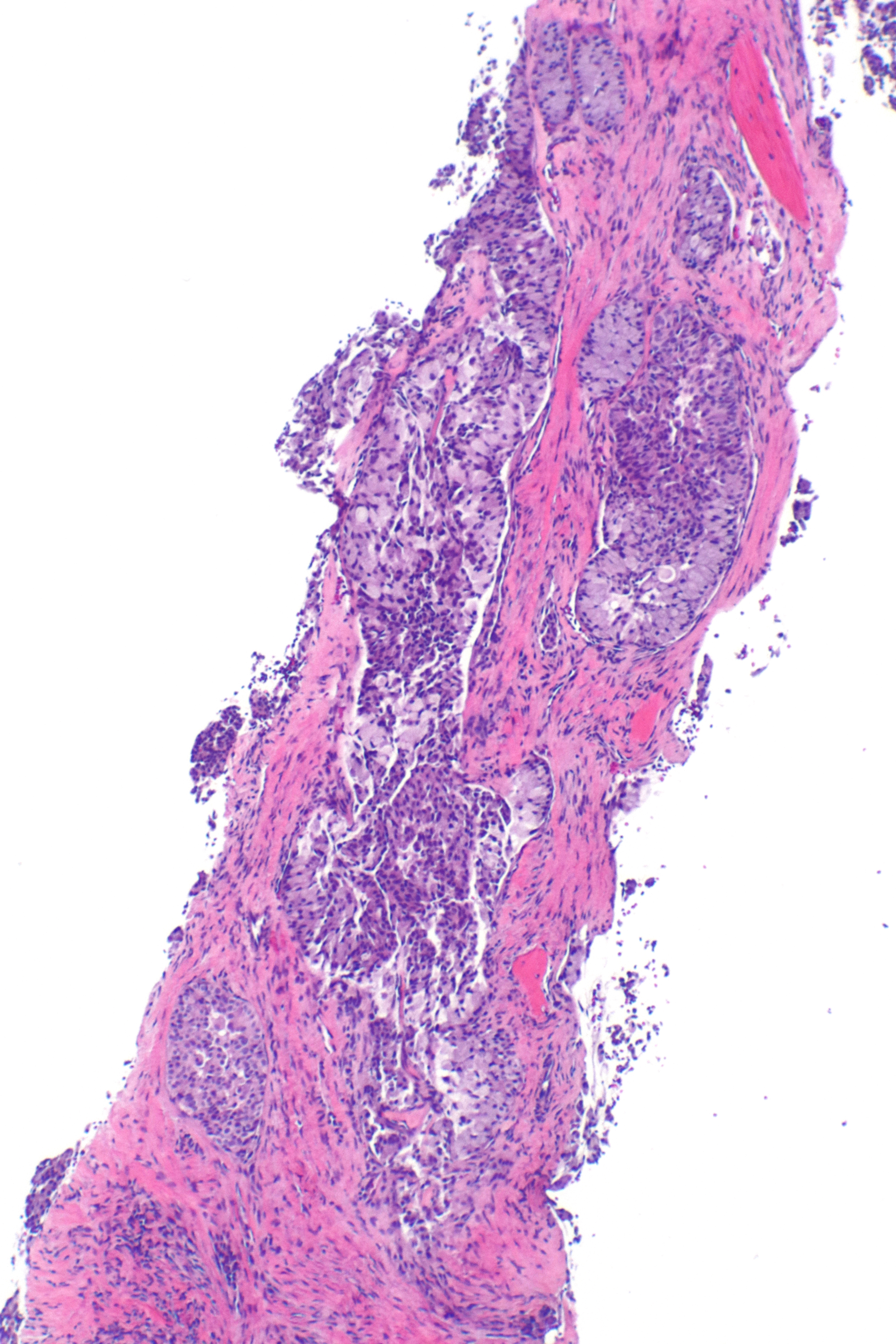 Histopathology of ALK-positive lung adenocarcinoma