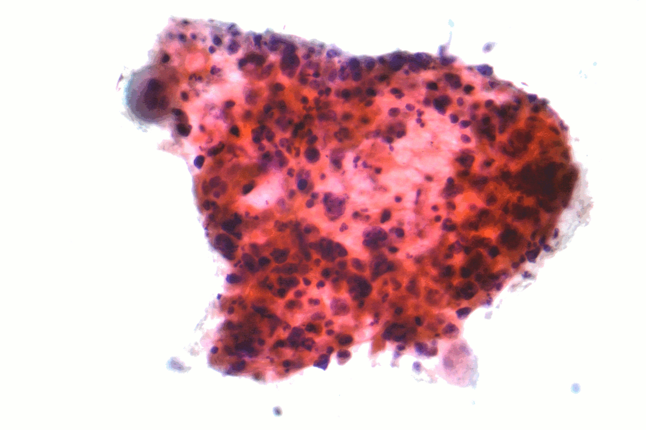 Micrograph of squamous cell carcinoma of the lung