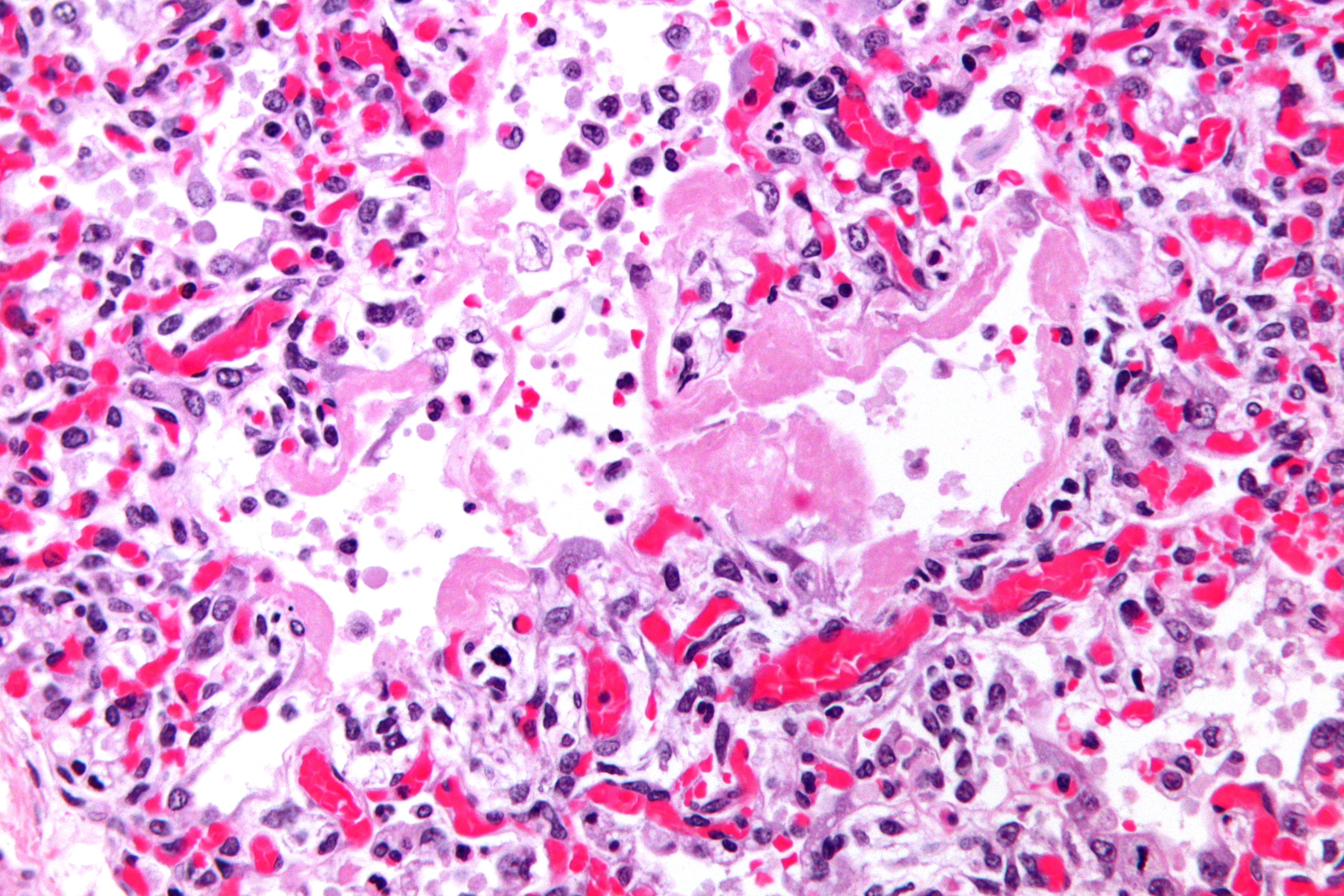 Hyaline membranes in the lung