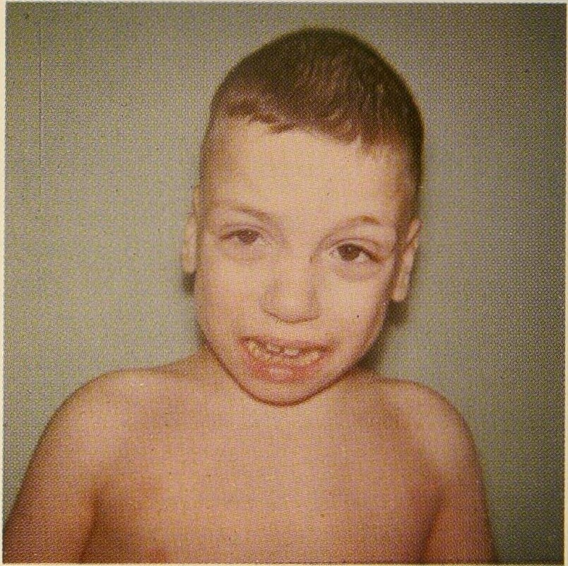 Morquio syndrome