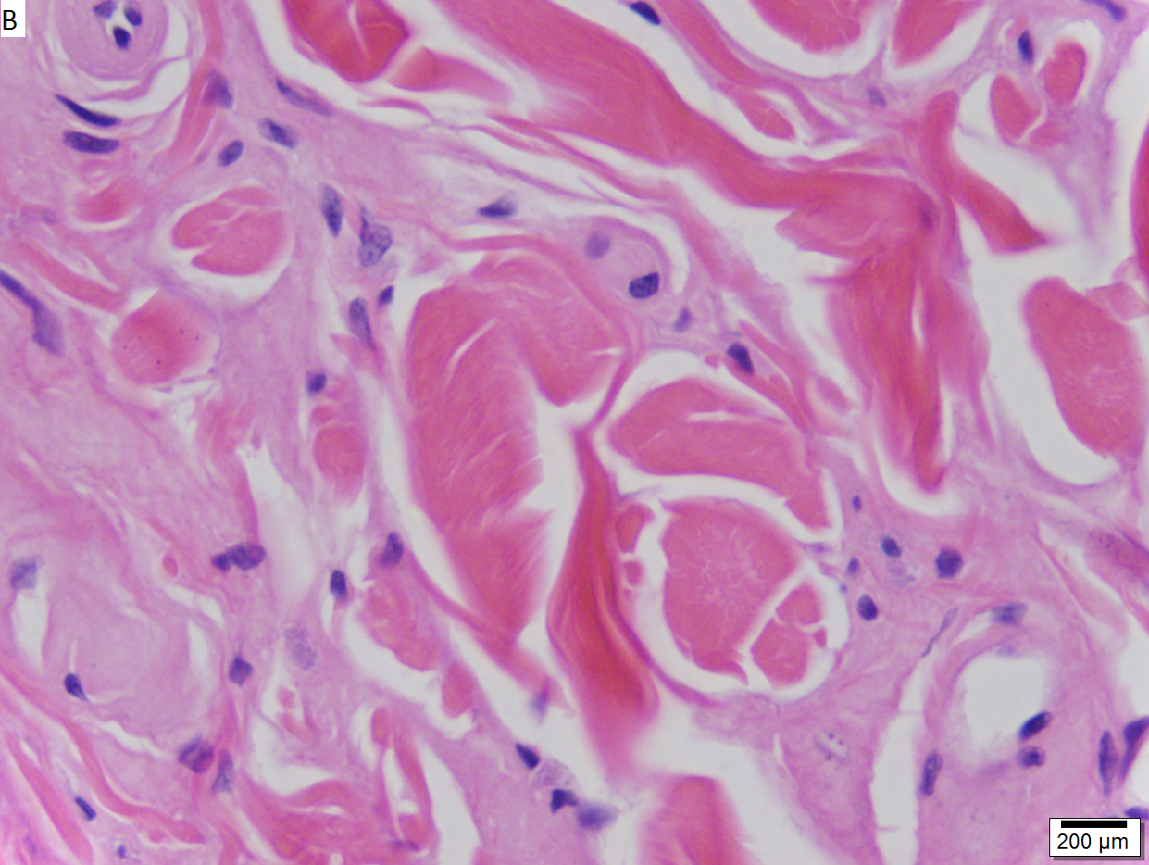 CT scan of a brain with Urbach–Wiethe disease
