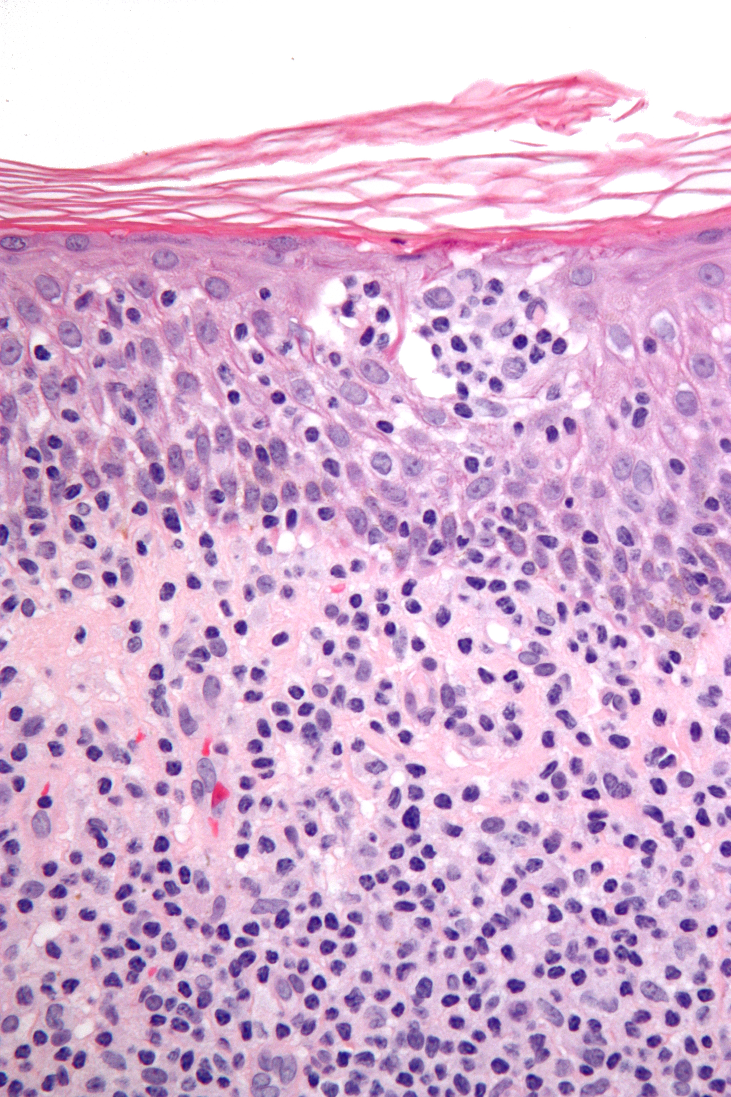 Micrograph of cutaneous T-cell lymphoma