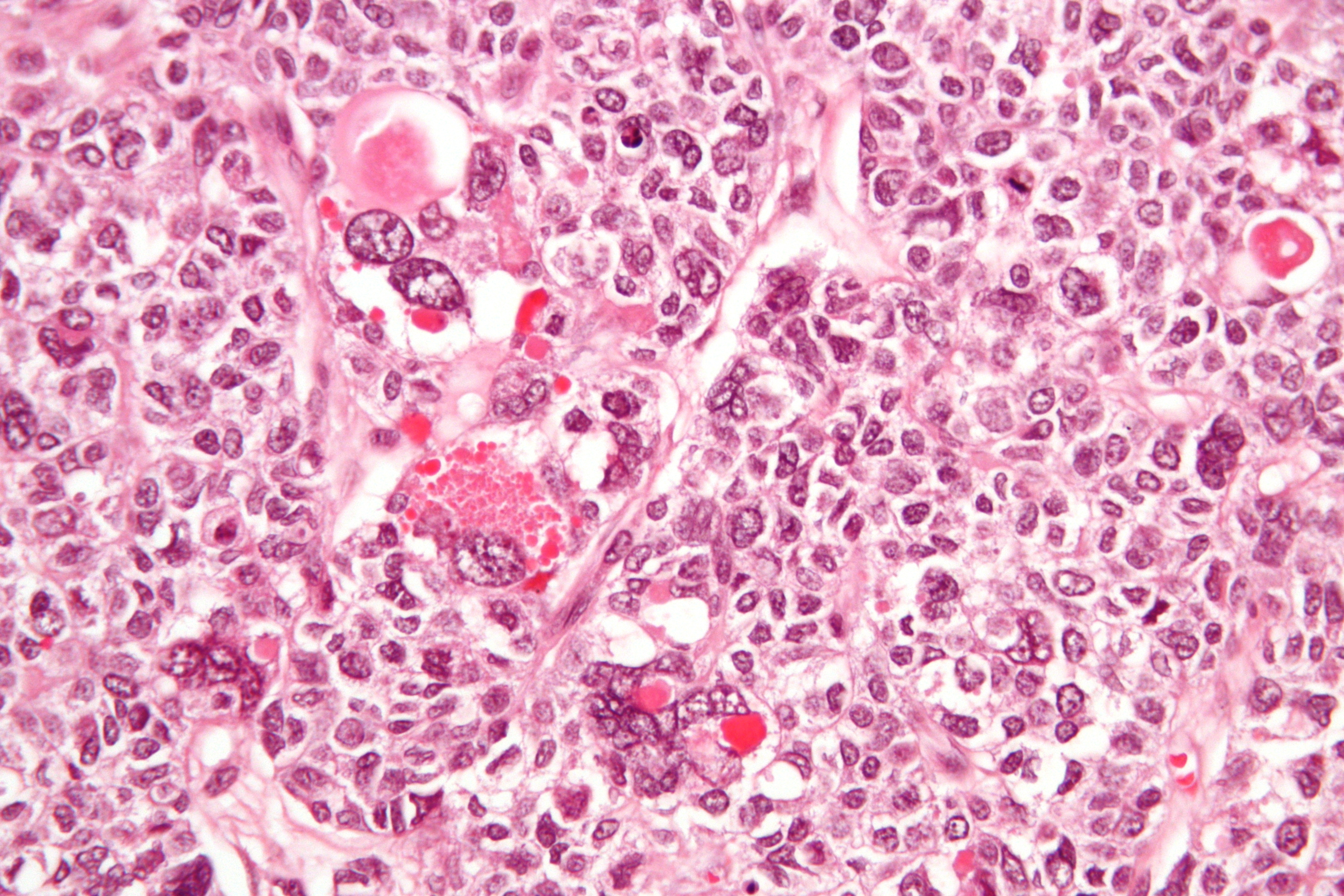 Micrograph of a juvenile granulosa cell tumour