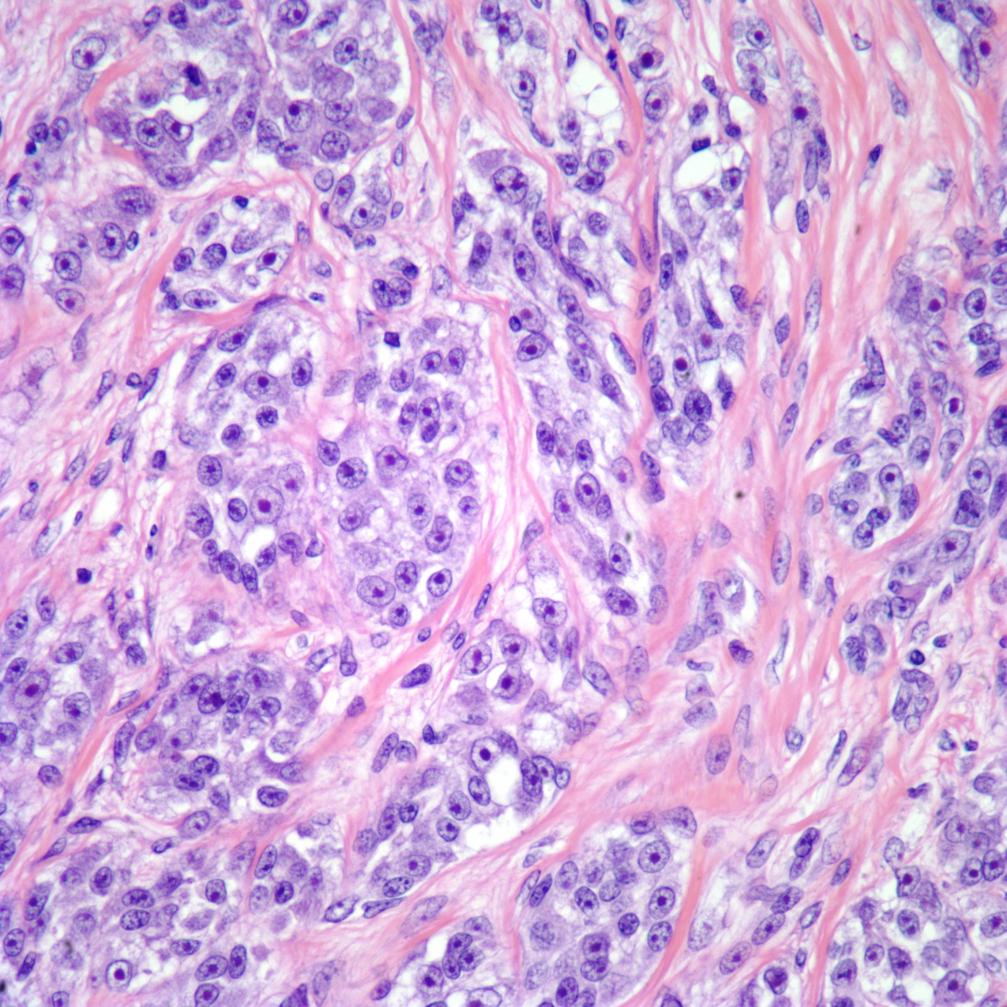 Clear cell sarcoma