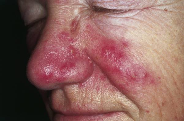 Rosacea on the face