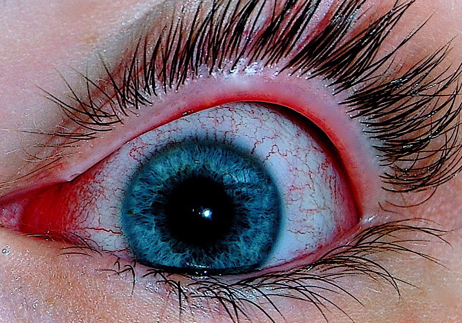 An eye with viral conjunctivitis