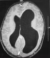 Megalencephaly