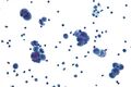 Serous carcinoma cytology