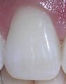 Right Central Incisor