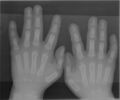 Syndactyly type 1 hands