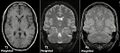 Magnetic resonance imaging