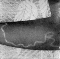 Tropical Diseases - Fig 149
