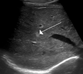 Hemangioma