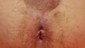 Post Transperineal Biopsy