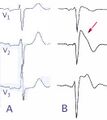 ECG changes in Brugada syndrome