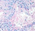 Hemosiderosis