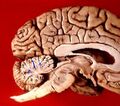 Cerebellar vermis