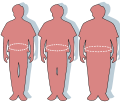 Obesity Waist Circumference