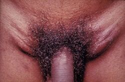 Lymphogranuloma venerum - lymph nodes