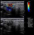 Elastography image of papillary thyroid carcinoma.