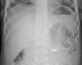 9mm battery in intestines