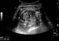 Cortical solid mass of renal cell carcinoma