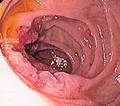 Duodenal adenocarcinoma