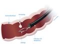 Colonic polypectomy