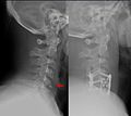 Teardrop fracture