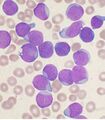 Acute leukemia - ALL