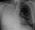 X-ray showing pneumonectomy