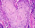 Carcinoma planoepitheliale keratodes laryngis (well differentiated)