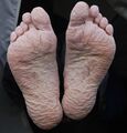 Trench foot