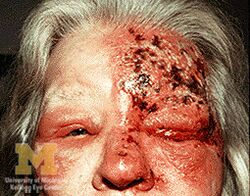 Trigeminal herpes uveitis and keratitis
