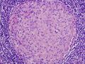 Granuloma formation in fungal sinusitis