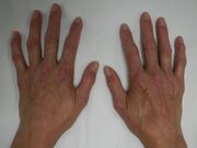 CREST syndrome (calcinosis and sclerodactyly)