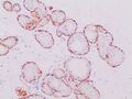 Immunohistochemistry with calponin in ductal carcinoma in situ