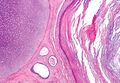 Teratoma showing differentiation of germ layers