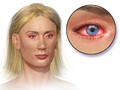 Allergic conjunctivitis illustration