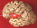 Primary_polydipsia