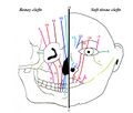 Craniofacial cleft