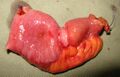 Gross pathology of small intestinal adenocarcinoma, serosal view