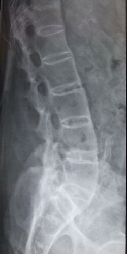 Ankylosing spondylitis lumbar spine