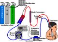 Extracorporeal membrane oxygenation