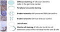 Distribution patterns of CD21 or CD23 in follicular lymphoma