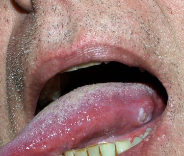 Epithelioma spinocellulare in58-year-old man. Diagnosis was histologically verified. Klaus D. Peter, Gummersbach, Germany Creative Commons Attribution 3.0 de